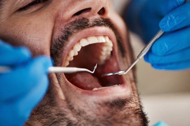Best Emergency Tooth Extraction in Lake Holiday, VA